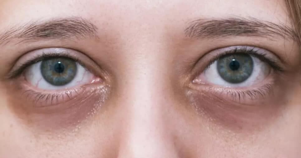 Coloque esse chá popular nos olhos e suma com olheiras e aspecto de cansada sem procedimentos