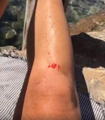 Luana Piovani exibe machucado na perna após acidente (Foto: Reprodução/Instagram) Luana Piovani exibe machucado na perna após acidente (Foto: Reprodução/Instagram)