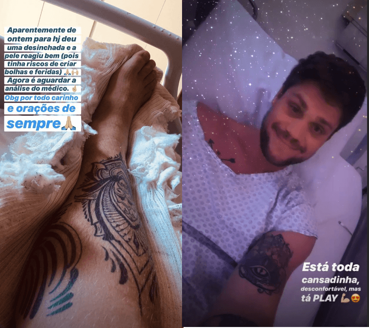 Ex-participante do BBB Breno Simões fraturou o tornozelo (Foto: Reprodução/ Instagram) Ex-participante do BBB Breno Simões fraturou o tornozelo (Foto: Reprodução/ Instagram)
