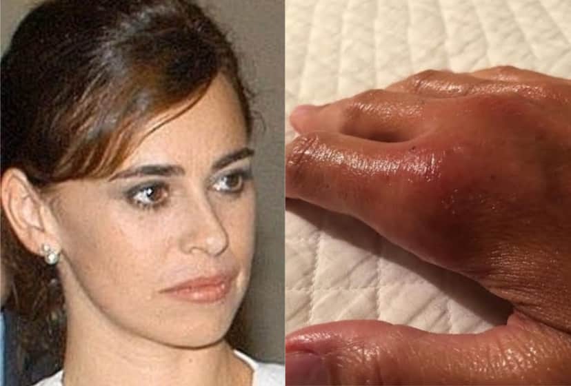 Daniela Escobar após ser mordida por seu gato (Foto: montagem TV Foco) Daniela Escobar após ser mordida por seu gato (Foto: montagem TV Foco)