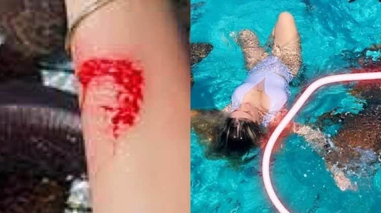 Influencer Ana Bruna Avila mostra como ficou a mordida de tubarão depois do susto (Montagem: TV Foco) Influencer Ana Bruna Avila mostra como ficou a mordida de tubarão depois do susto (Montagem: TV Foco)
