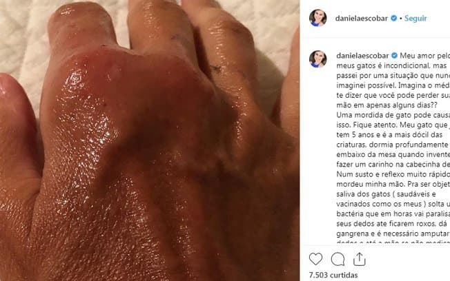 Mão de Daniela Escobar ficou infeccionada após mordida de gato (Foto: Reprodução/Instagram) Mão de Daniela Escobar ficou infeccionada após mordida de gato (Foto: Reprodução/Instagram)