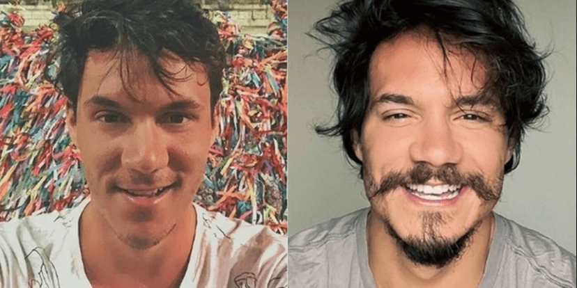 Eliezer antes e depois da harmonização facial (Foto: reprodução) Eliezer antes e depois da harmonização facial (Foto: reprodução)