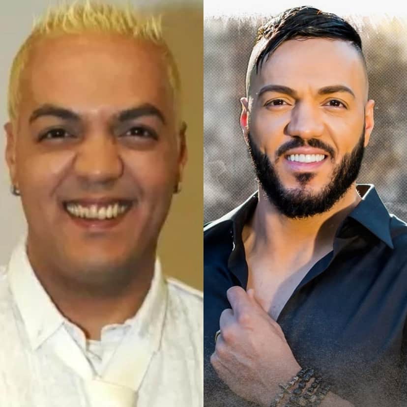 Antes de depois do sorriso do artista Belo Antes de depois do sorriso do artista Belo