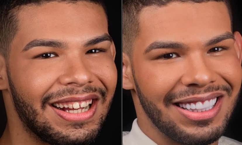 Conceituado nas redes, Vyni exibe seu novo sorriso conquistado com a fama e fortuna Conceituado nas redes, Vyni exibe seu novo sorriso conquistado com a fama e fortuna