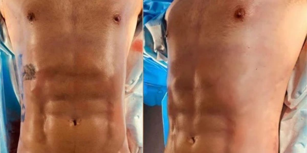 Novo visual do corpo de Caio Afiune após a cirurgia para corrigir ginecomastia (Reprodução: Instagram) Novo visual do corpo de Caio Afiune após a cirurgia para corrigir ginecomastia (Reprodução: Instagram)