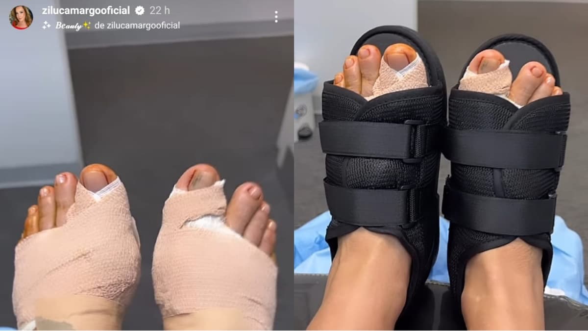 Zilu Godoy mostra seus pés enfaixados, confirma que houve necessidade de cirurgia e mostra roxo de pancada Zilu Godoy mostra seus pés enfaixados, confirma que houve necessidade de cirurgia e mostra roxo de pancada
