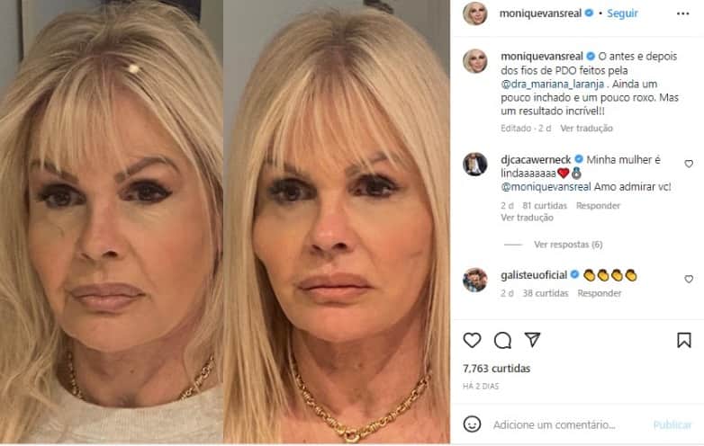 Monique Evans realizou procedimento estético no rosto e surgiu nas redes sociais para mostrar a diferença gritante entre antes e depois para seus fãs e seguidores (Foto: Reprodução/Instagram) Monique Evans realizou procedimento estético no rosto e surgiu nas redes sociais para mostrar a diferença gritante entre antes e depois para seus fãs e seguidores (Foto: Reprodução/Instagram)
