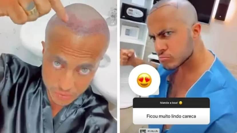 Thammy Miranda, filho de Gretchen, pegou o Brasil de surpresa ao surgir totalmente careca e deu detalhes de procedimento que realizou - Foto Reprodução Instagram Thammy Miranda, filho de Gretchen, pegou o Brasil de surpresa ao surgir totalmente careca e deu detalhes de procedimento que realizou - Foto Reprodução Instagram