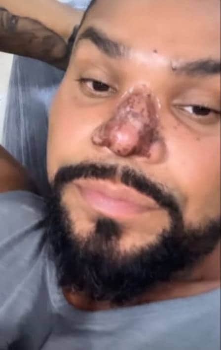 um princípio de necrose no local - Foto Reprodução Instagram - Foto Reprodução Instagram um princípio de necrose no local - Foto Reprodução Instagram - Foto Reprodução Instagram