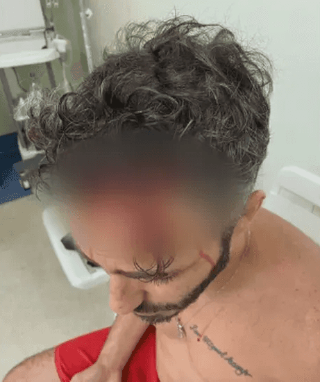 Machucado na cabeça de Thiago Rodrigues (Foto: Divulgação) Machucado na cabeça de Thiago Rodrigues (Foto: Divulgação)