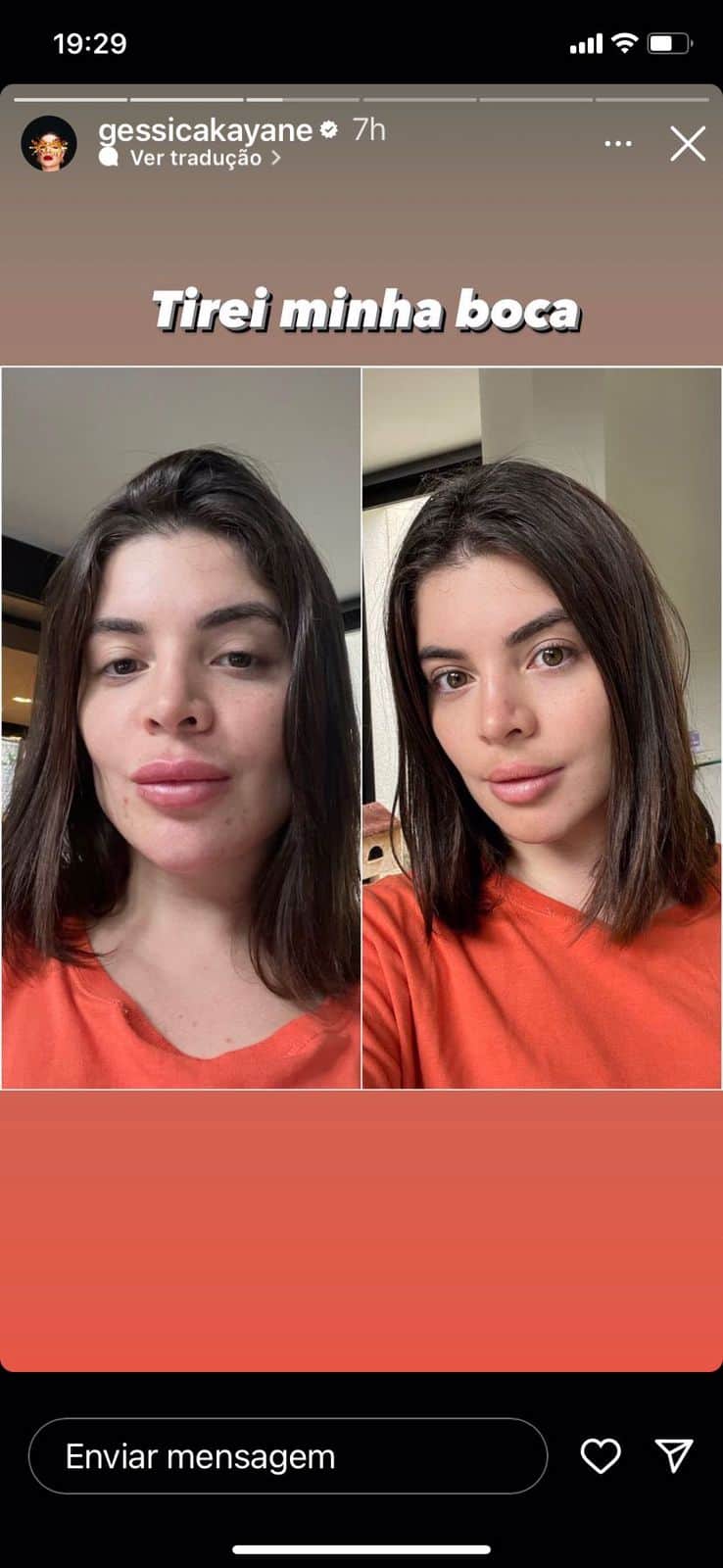 Gkay mostrou nas redes sociais como está após as mudanças de retirada das harmonizações (Reprodução - Instagram) Gkay mostrou nas redes sociais como está após as mudanças de retirada das harmonizações (Reprodução - Instagram)