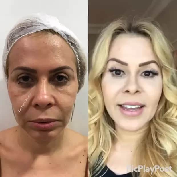 Joelma em antes e depois da armonização - Foto Reprodução Instagram Joelma em antes e depois da armonização - Foto Reprodução Instagram