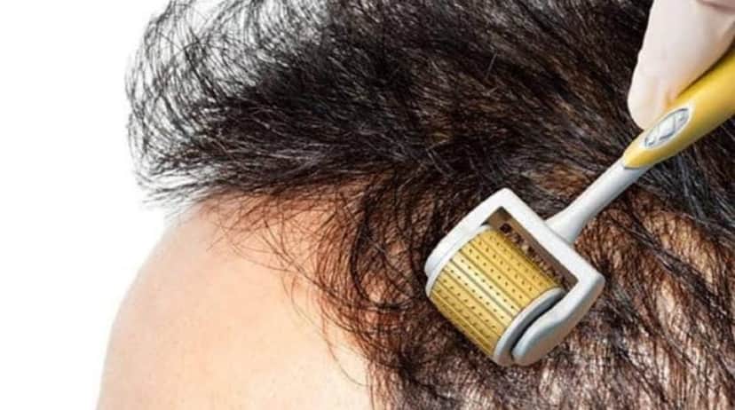 O microagulhamento capilar é um dos processos que fazem o cabelo voltar a crescer (Reprodução: Internet) O microagulhamento capilar é um dos processos que fazem o cabelo voltar a crescer (Reprodução: Internet)