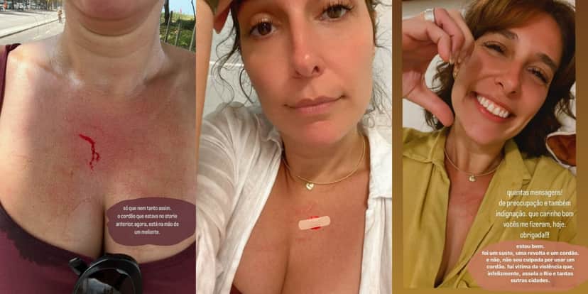 Natasha Dantas, esposa de William Bonner, mostrou busto com sangue após furto (Foto: Reprodução/Instagram) Natasha Dantas, esposa de William Bonner, mostrou busto com sangue após furto (Foto: Reprodução/Instagram)