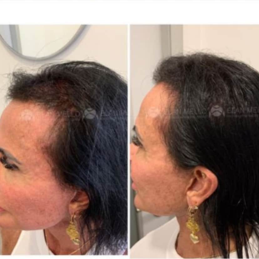 Procedimento capilar feito por Gretchen (Reprodução - Instagram) Procedimento capilar feito por Gretchen (Reprodução - Instagram)