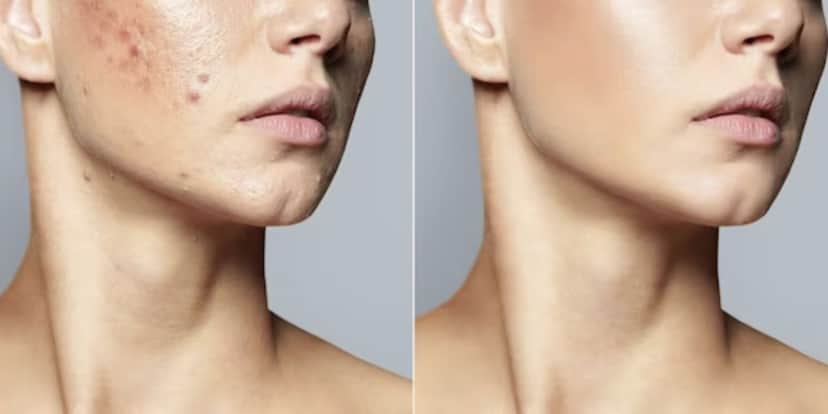 Antes e depois acne após usar ingrediente (Foto: Reprodução / Freepik) Antes e depois acne após usar ingrediente (Foto: Reprodução / Freepik)