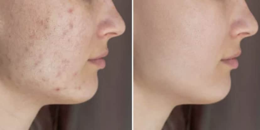 Antes e depois de manchas (Foto: Reprodução / Internet) Antes e depois de manchas (Foto: Reprodução / Internet)