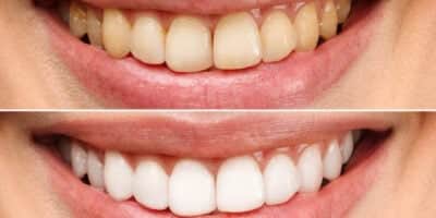 Dentes Brancos e sorriso perfeito com essa receita (Foto: Divulgação) Dentes Brancos e sorriso perfeito com essa receita (Foto: Divulgação)