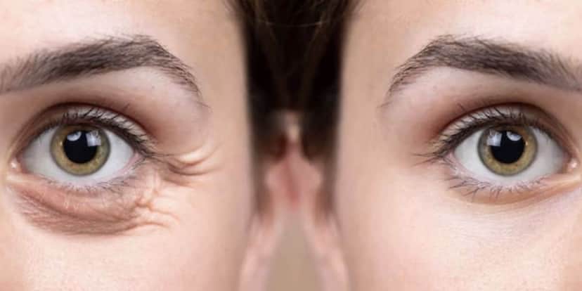 Antes e depois de pálpebra caída (Foto: Reprodução / Freepik) Antes e depois de pálpebra caída (Foto: Reprodução / Freepik)