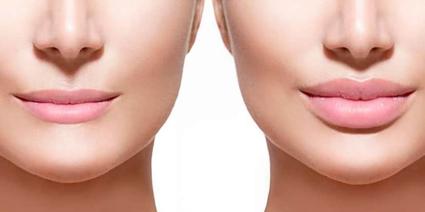 Antes e depois de um Preenchimento labial (Foto: Reprodução - Reference Smile) Antes e depois de um Preenchimento labial (Foto: Reprodução - Reference Smile)