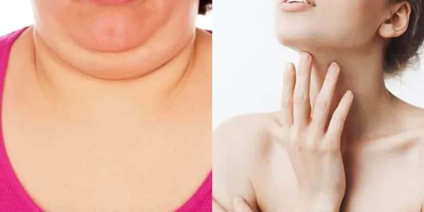 Mulher com papada / Mulher sem papada - Montagem TVFOCO Mulher com papada / Mulher sem papada - Montagem TVFOCO
