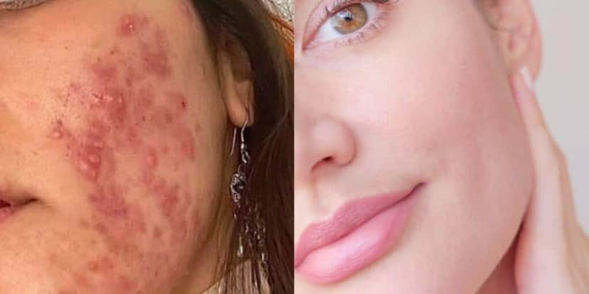 Pele com espinhas / Pele sem espinhas - Montagem TVFOCO Pele com espinhas / Pele sem espinhas - Montagem TVFOCO