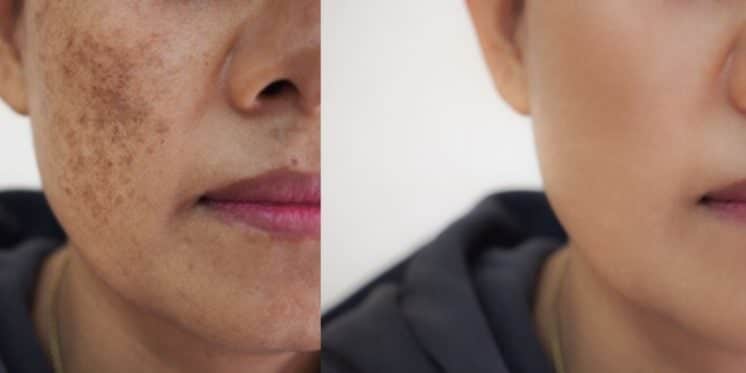 Manchas escuras, antes e depois (Reprodução/Internet) Manchas escuras, antes e depois (Reprodução/Internet)