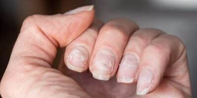 Unhas quebradiças (Foto: Reprodução/ Internet) Unhas quebradiças (Foto: Reprodução/ Internet)