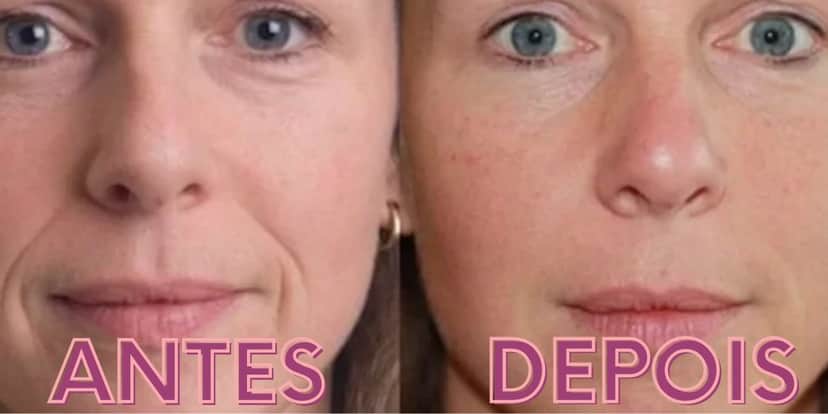 Evolução do extermínio das rugas com a utilização de um único produto (Reprodução: Montagem TV Foco) Evolução do extermínio das rugas com a utilização de um único produto (Reprodução: Montagem TV Foco)