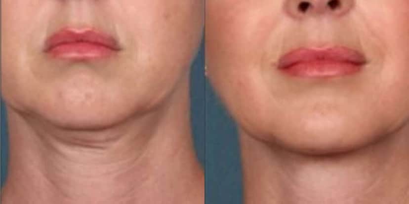 Rosto com Papada antes e depois de exercícios (Foto: Divulgação) Rosto com Papada antes e depois de exercícios (Foto: Divulgação)