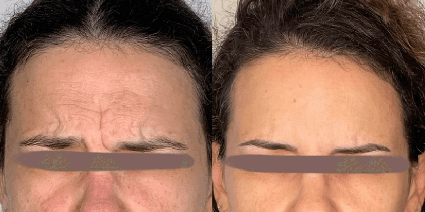 Antes e depois do botox - foto: TV Foco Antes e depois do botox - foto: TV Foco