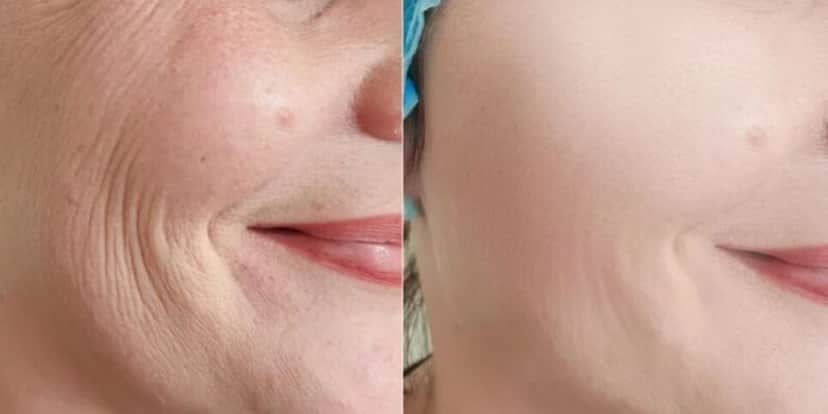 Mulher com rugas / Mulher sem rugas - Montagem: TVFOCO Mulher com rugas / Mulher sem rugas - Montagem: TVFOCO