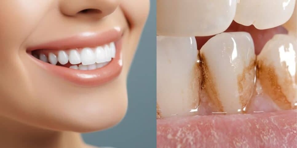 Adeus dentes amarelos: Clareamento natural com sal e +1 item deixa o sorriso brilhando sem gastar 1 real