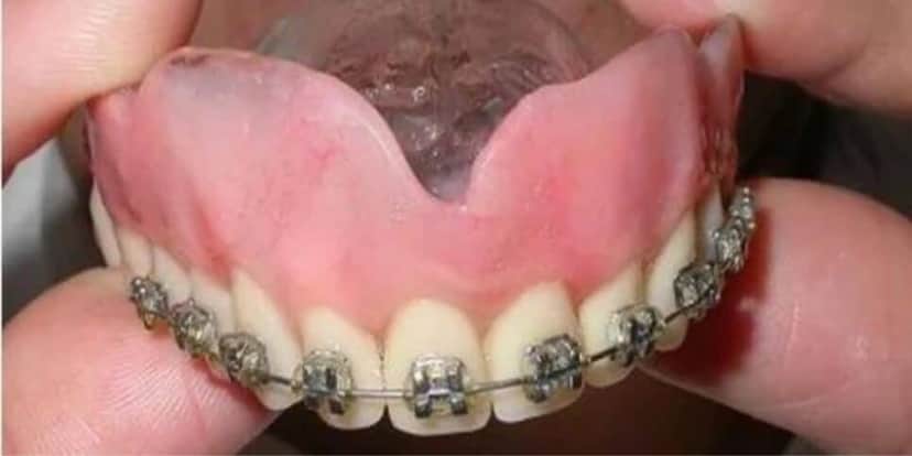 Aparelho na dentadura rejuvenesce a pessoa (Reprodução: Internet) Aparelho na dentadura rejuvenesce a pessoa (Reprodução: Internet)