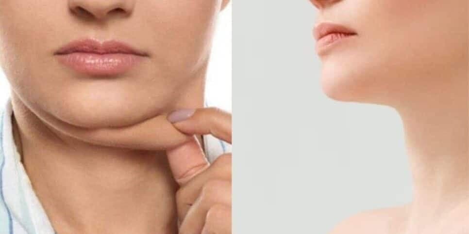 Com papada / Sem papada - Montagem: TVFOCO Com papada / Sem papada - Montagem: TVFOCO
