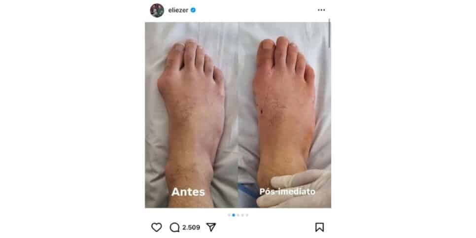 Eliezer usa as redes sociais para mostrar resultado de cirurgia (Foto: Internet) Eliezer usa as redes sociais para mostrar resultado de cirurgia (Foto: Internet)