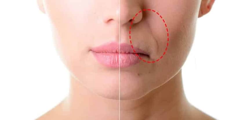 Bigode Chinês e rugas tem um fim com essa receita (Foto: Montagem) Bigode Chinês e rugas tem um fim com essa receita (Foto: Montagem)
