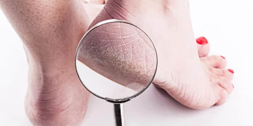 Adeus a pés rachados com esses ingredientes (Foto: Montagem) Adeus a pés rachados com esses ingredientes (Foto: Montagem)