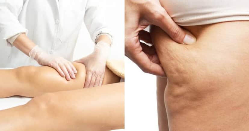 Adeus celulite com essa drenagem linfática caseira (Foto: Montagem) Adeus celulite com essa drenagem linfática caseira (Foto: Montagem)
