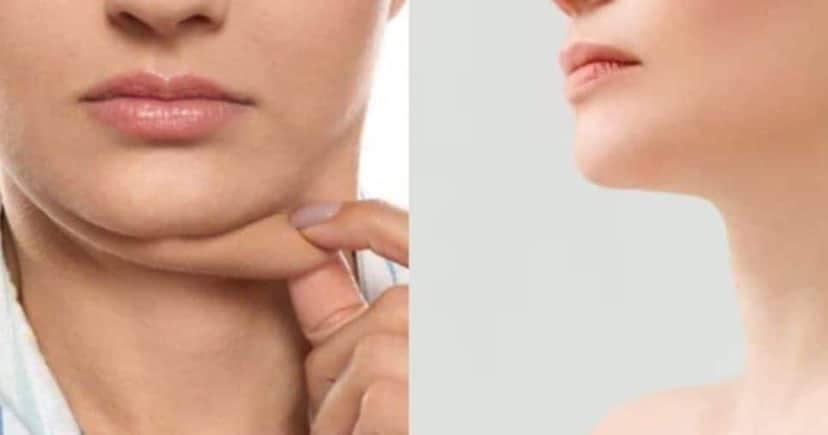Adeus papada com essas dicas (Foto: Divulgação) Adeus papada com essas dicas (Foto: Divulgação)