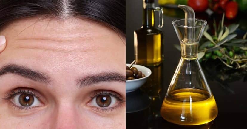 Harmonização Facial, Rugas Botox Harmonização Facial, Rugas Botox