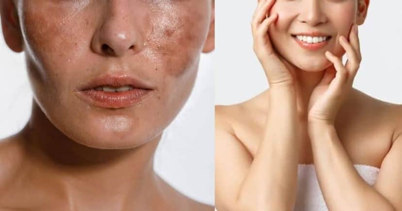 Pele com manchas / Pele sem manchas - Montagem: TVFOCO Pele com manchas / Pele sem manchas - Montagem: TVFOCO