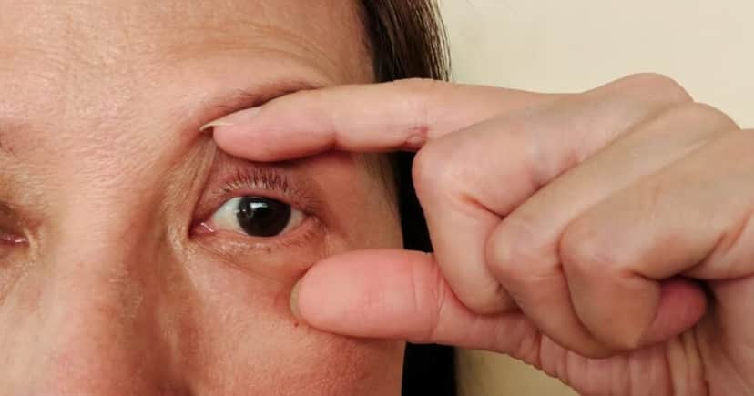 Sintoma nos olhos que pode sinalizar diabetes fora de controle - Foto: internet Sintoma nos olhos que pode sinalizar diabetes fora de controle - Foto: internet