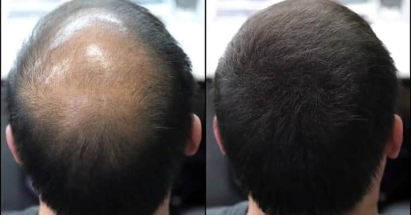 Homem, calvície antes e depois (Foto: Reprodução/ Internet) Homem, calvície antes e depois (Foto: Reprodução/ Internet)