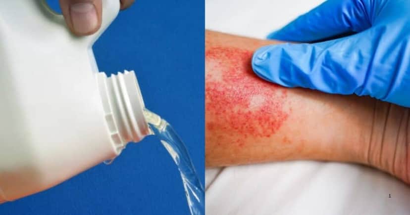 Água Sanitária sem registro pode causar queimaduras na pele (Foto Reprodução/Montagem/Tv Foco/Canva/Lennita) Água Sanitária sem registro pode causar queimaduras na pele (Foto Reprodução/Montagem/Tv Foco/Canva/Lennita)
