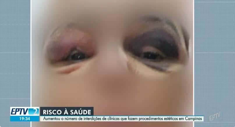Hematomas e inchaço na vítima causado pelo procedimento estético em uma clínica de Campinas (Foto Reprodução/EPTV/Globo) Hematomas e inchaço na vítima causado pelo procedimento estético em uma clínica de Campinas (Foto Reprodução/EPTV/Globo)