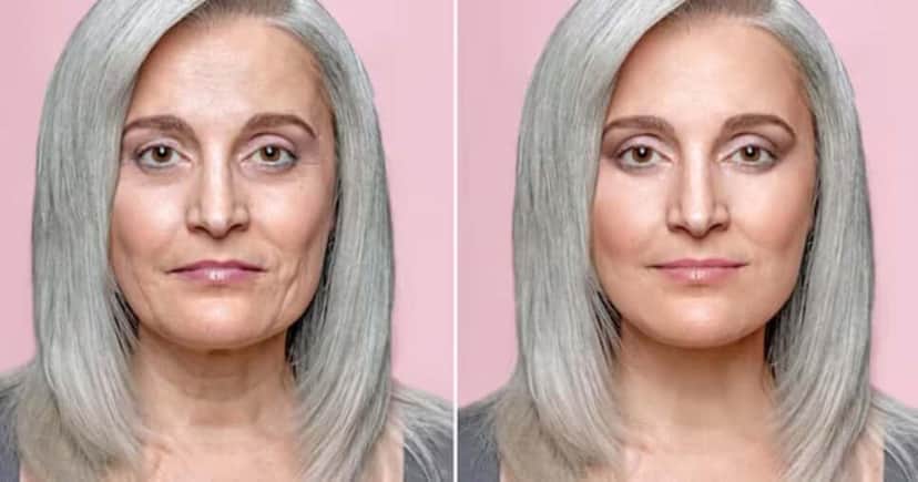 Antes e depois de mulher com rugas na pele (Foto: Freepik) Antes e depois de mulher com rugas na pele (Foto: Freepik)