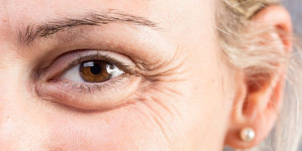 Mulher com rugas ao redor dos olhos (Foto: Canva) Mulher com rugas ao redor dos olhos (Foto: Canva)