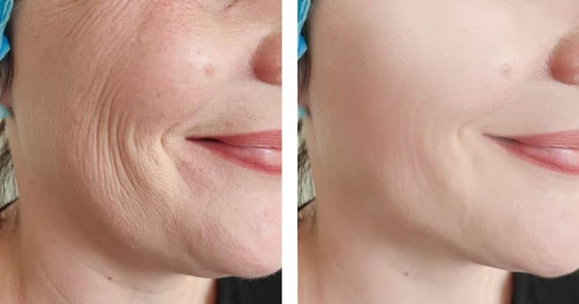 Mistura natural com 2 ingredientes apaga rugas (Reprodução/Montagem TV Foco/Canva) Mistura natural com 2 ingredientes apaga rugas (Reprodução/Montagem TV Foco/Canva)